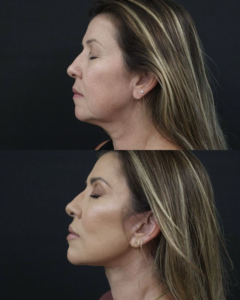 Contorno do rosto antes e depois do tratamento