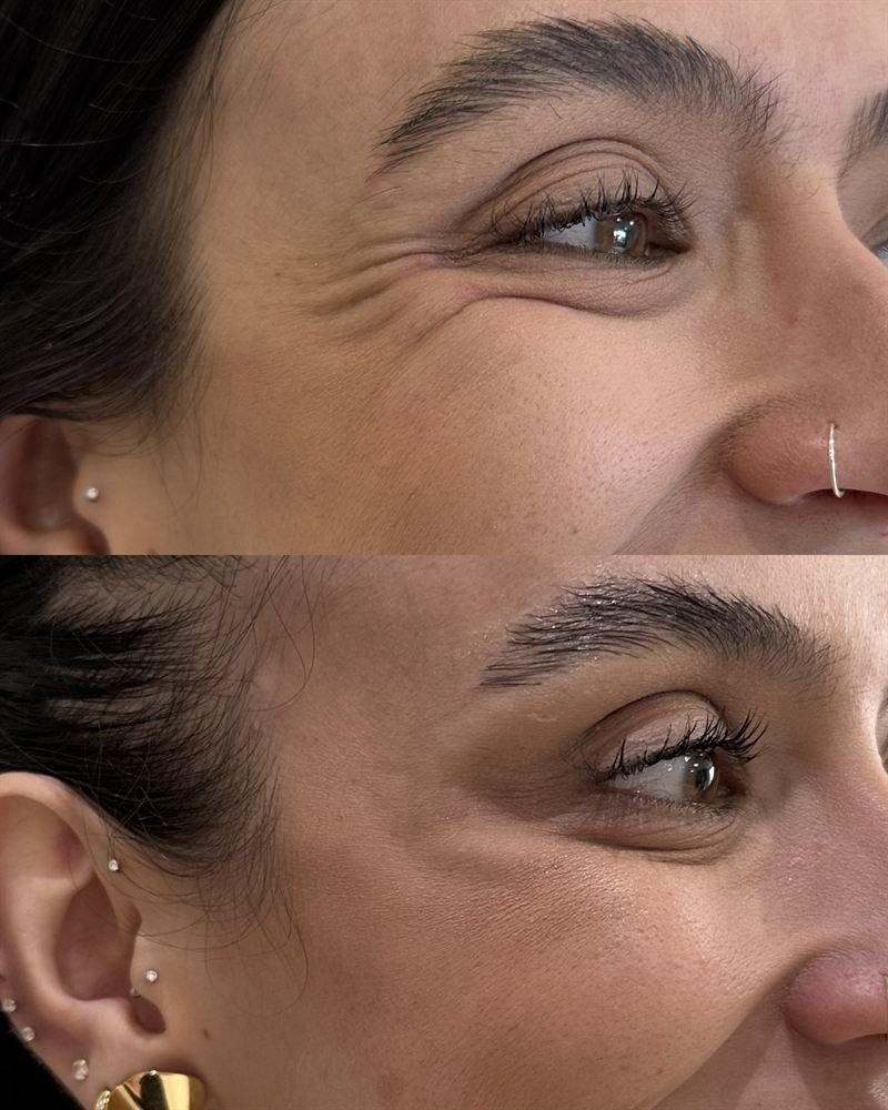 Região dos olhos antes e depois do tratamento