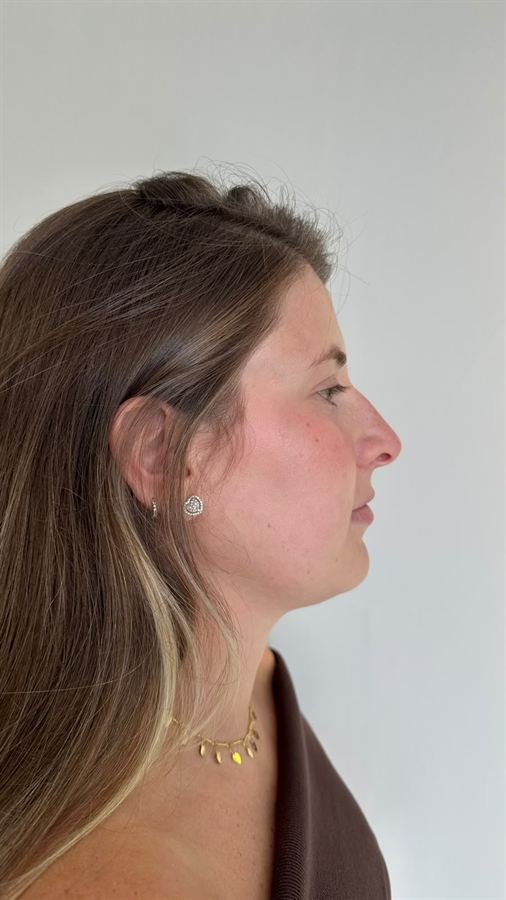 Perfil antes do tratamento