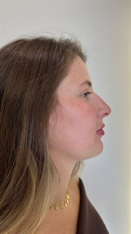 Perfil depois do tratamento