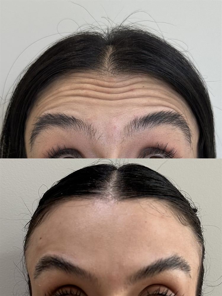Região da testa antes e depois do tratamento